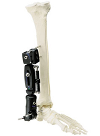 External Fixation - X-Caliber Ankle